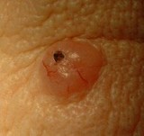 basal cell